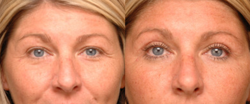 eyelid1 Eyelid Surgery in Akron, OH