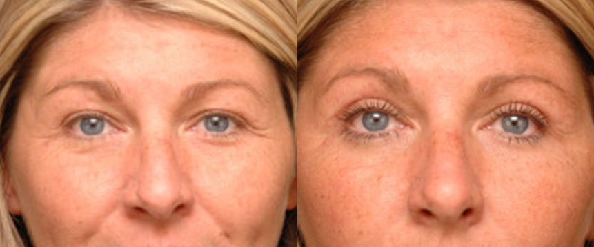 Eyelid Surgery in Akron, OH