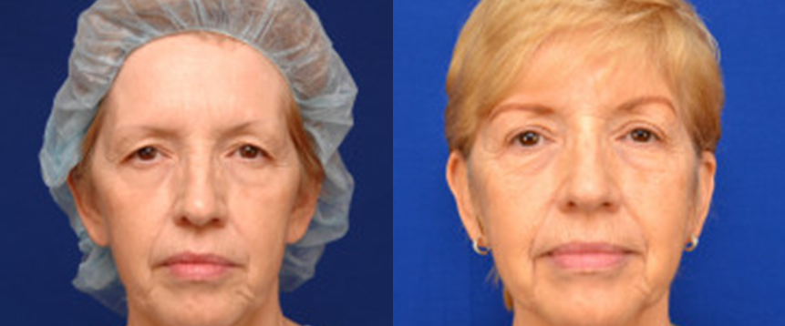 Eyelid Surgery in Akron, OH