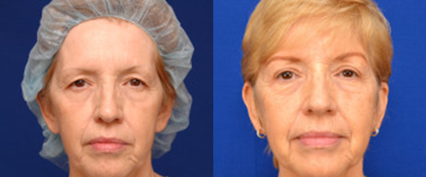 eyelid2 Eyelid Surgery in Akron, OH