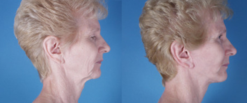 Facial Surgery in Akron, OH