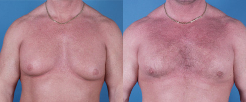 Gynecomastia in Akron, OH