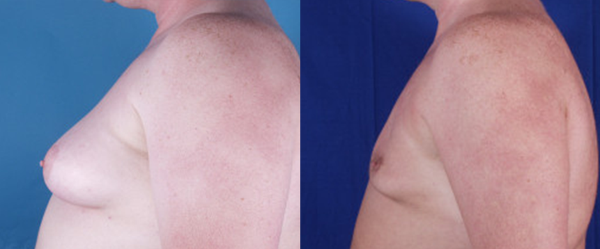 Gynecomastia in Akron, OH