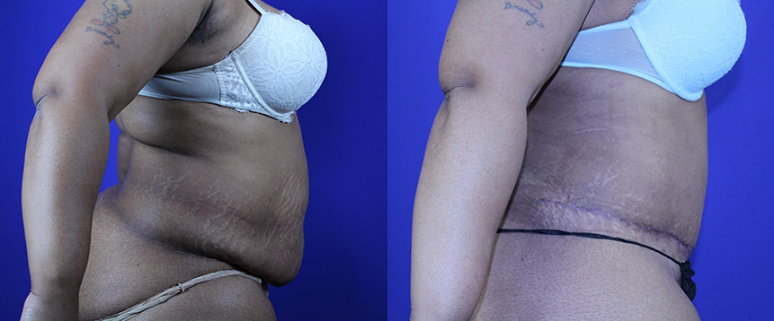 Liposuction in Akron, OH