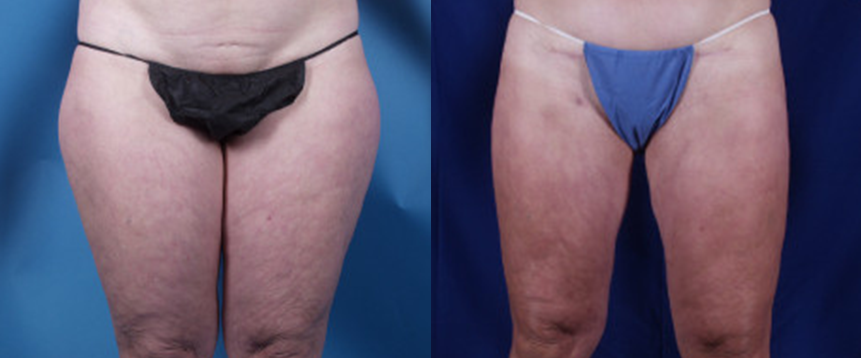 Liposuction in Akron, OH