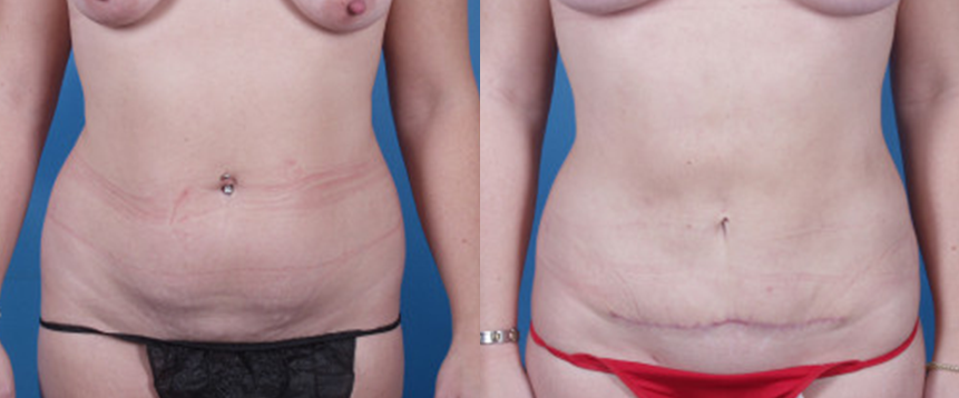 Mini Tummy Tuck in Akron, OH