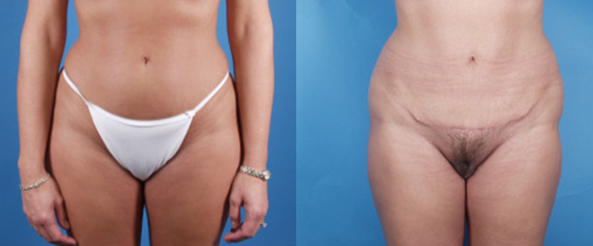 Mini Tummy Tuck in Akron, OH