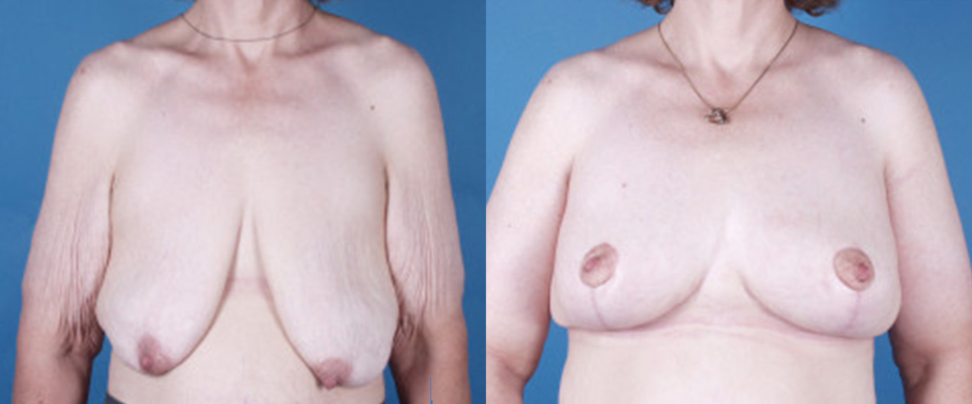 Breast Reconstruction in Akron, OH
