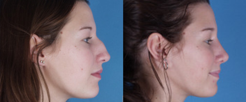 Rhinoplasty in Akron, OH