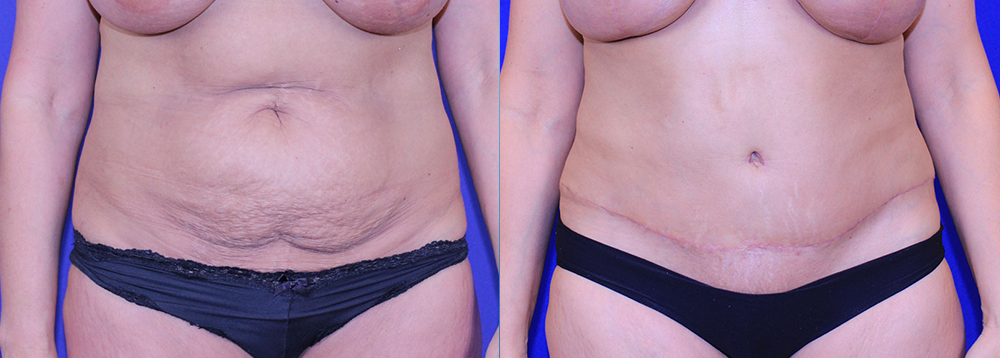 Tummy Tuck in Akron, OH